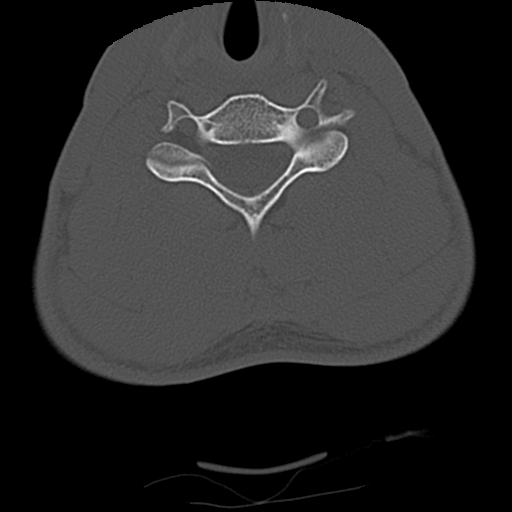 File:Apical pneumothorax on cervical spine CT (Radiopaedia 45343-49368 Axial bone window 61).jpg