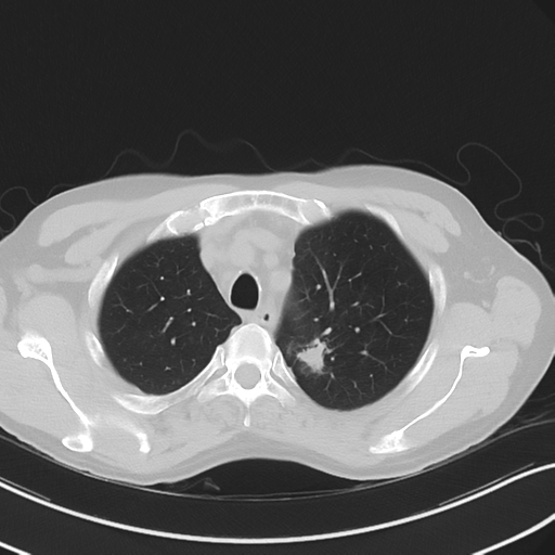 Apical pulmonary metastasis (Radiopaedia 46338-50754 Axial non-contrast 16).png