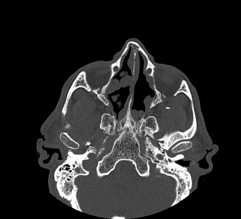 Aplastic maxillary sinuses (Radiopaedia 60030-67561 Axial non-contrast 35).jpg