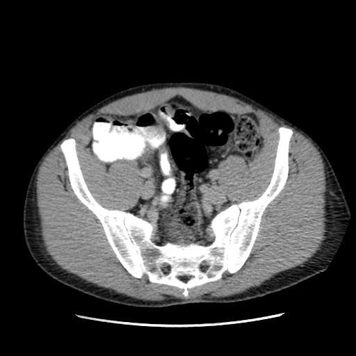 File:Appendicitis complicated by post-operative collection (Radiopaedia 35595-37113 A 59).jpg
