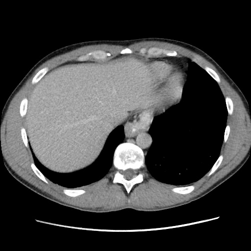 Appendicitis complicated by post-operative collection (Radiopaedia 35595-37114 A 13).jpg