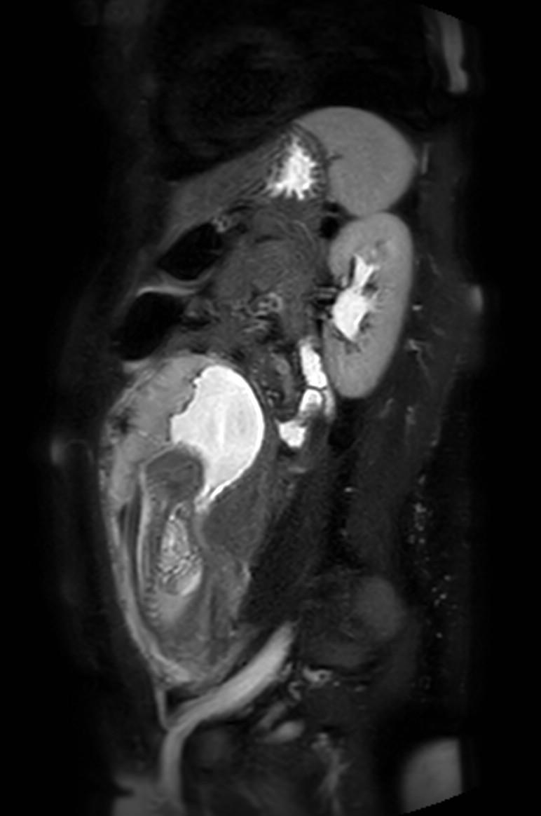 Appendicitis in gravida (MRI) (Radiopaedia 89433-106395 Sagittal T2 SPAIR 21).jpg