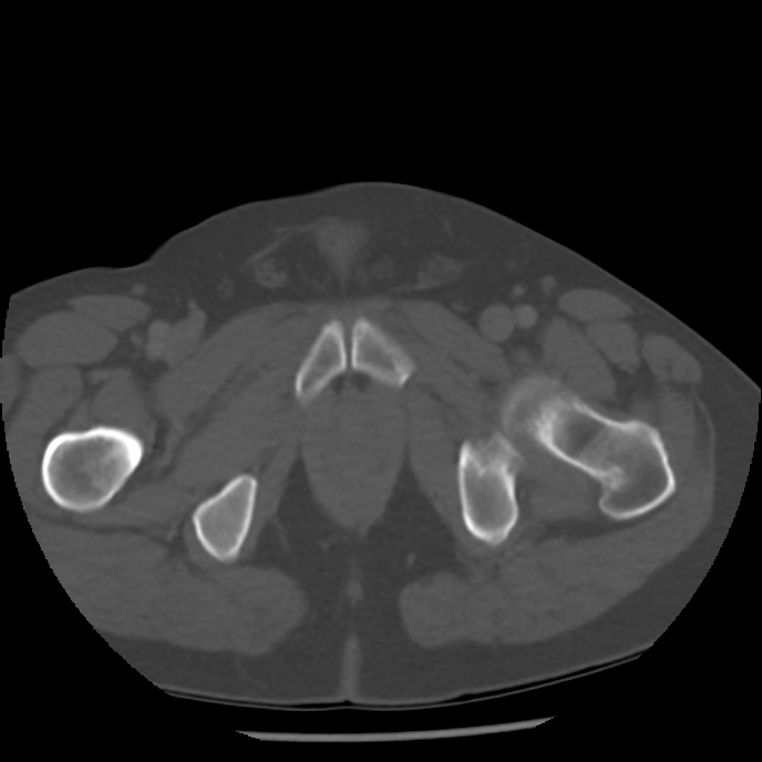 Appendicitis with perforation (Radiopaedia 35790-37342 Axial bone window 55).jpg