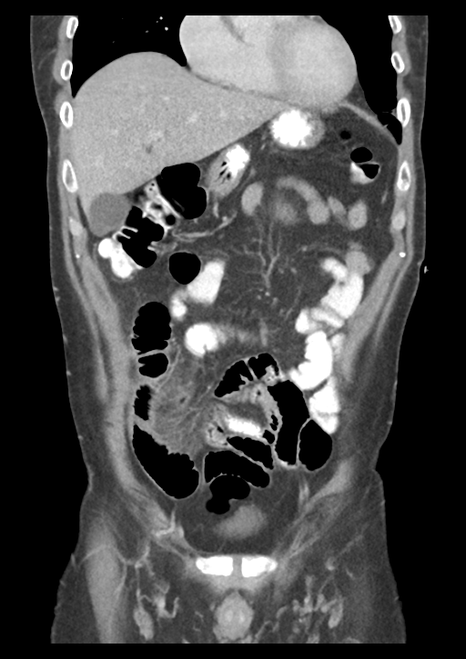 Appendicitis with thickening of the terminal ileum (Radiopaedia 42432-45550 B 17).png
