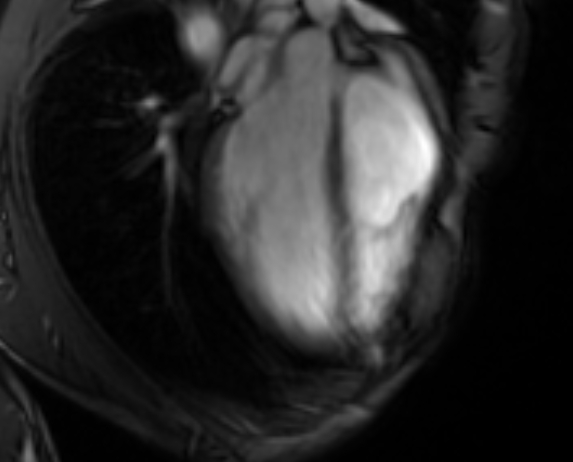 Arrhythmogenic right ventricular cardiomyopathy (Radiopaedia 69564-79464 4ch cine 38).jpg