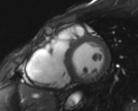 Arrhythmogenic right ventricular cardiomyopathy (Radiopaedia 69564-79464 short axis cine 143).jpg