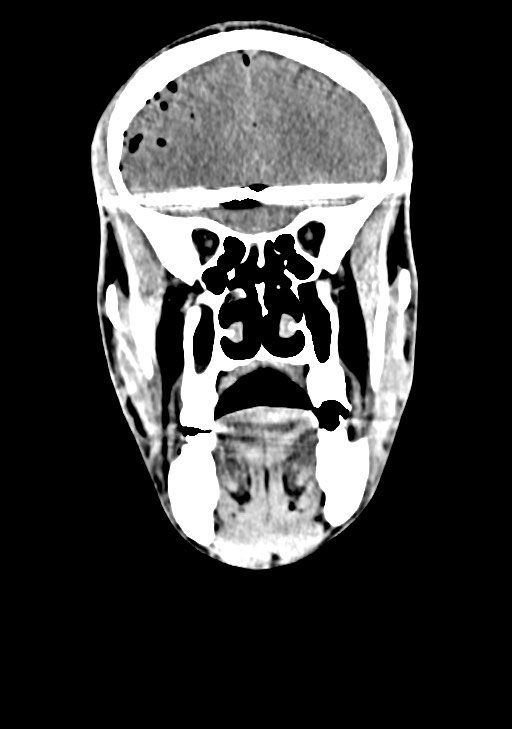 Arrow injury to the brain (Radiopaedia 72101-82607 Coronal non-contrast 27).jpg