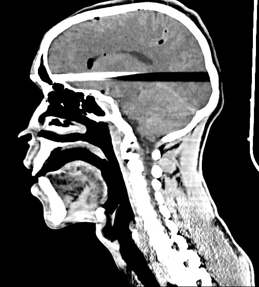Arrow injury to the brain (Radiopaedia 72101-82607 H 30).jpg