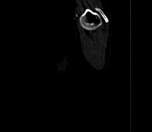 Arteria lusoria (Radiopaedia 88528-105192 C 8).jpg