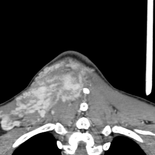 Arteriovenous malformation of the neck (Radiopaedia 53935-60062 D 55).jpg