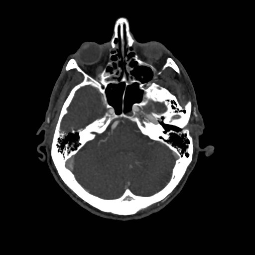 File:Artery of Percheron infarct (Radiopaedia 48088-52894 A 117).jpg