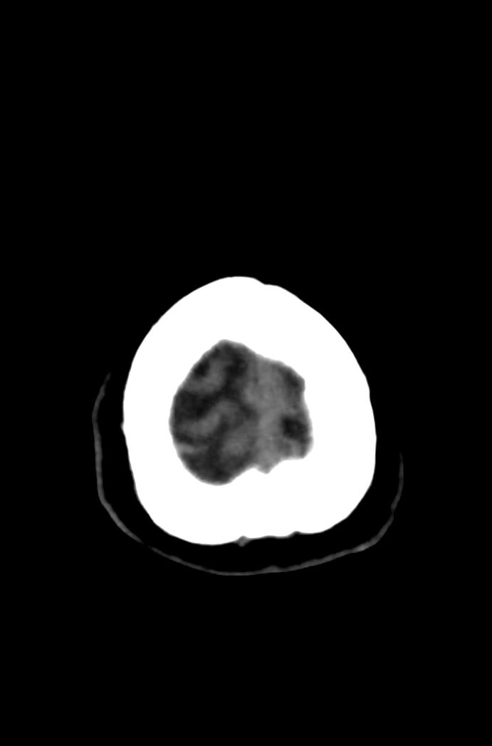 Artery of Percheron infarction (Radiopaedia 80613-94202 Axial non-contrast 183).jpg