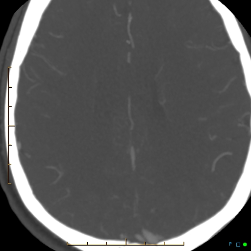 File:Artifactual basilar artery stenosis due to metallic stent (Radiopaedia 31206-31923 A 30).jpg