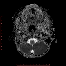 Astroblastoma (Radiopaedia 74287-85162 Axial ADC 3).jpg