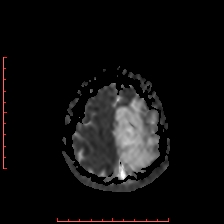 Astroblastoma (Radiopaedia 74287-85162 Axial ADC 61).jpg