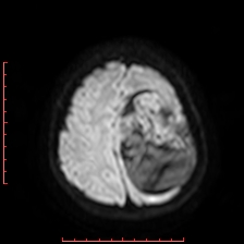 Astroblastoma (Radiopaedia 74287-85162 Axial DWI 90).jpg