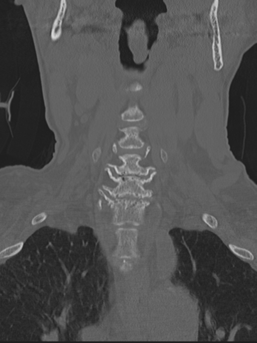 Atlanto-axial subluxation (Radiopaedia 36610-38176 Coronal bone window 14).png