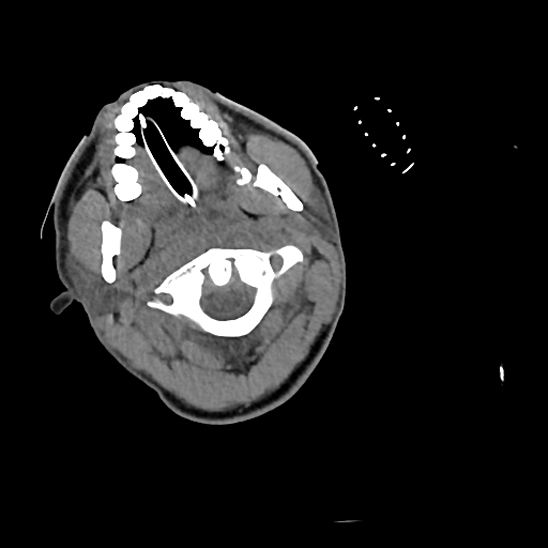 File:Atlanto-occipital dissociation (Traynelis type 1), C2 teardrop fracture, C6-7 facet joint dislocation (Radiopaedia 87655-104061 Axial non-contrast 15).jpg