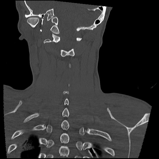 Atlanto-occipital dissociation (Traynelis type 1), C2 teardrop fracture, C6-7 facet joint dislocation (Radiopaedia 87655-104061 Coronal bone window 52).jpg