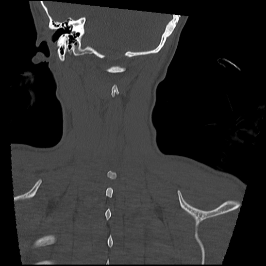 Atlanto-occipital dissociation (Traynelis type 1), C2 teardrop fracture, C6-7 facet joint dislocation (Radiopaedia 87655-104061 Coronal bone window 59).jpg