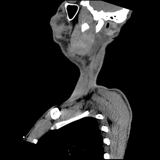 File:Atlanto-occipital dissociation (Traynelis type 1), C2 teardrop fracture, C6-7 facet joint dislocation (Radiopaedia 87655-104061 D 15).jpg