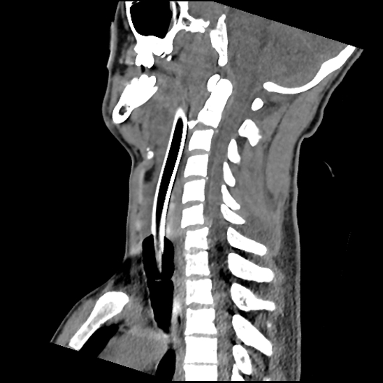 Atlanto-occipital dissociation (Traynelis type 1), C2 teardrop fracture, C6-7 facet joint dislocation (Radiopaedia 87655-104061 D 46).jpg