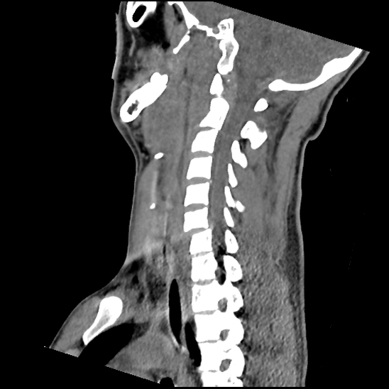 File:Atlanto-occipital dissociation (Traynelis type 1), C2 teardrop fracture, C6-7 facet joint dislocation (Radiopaedia 87655-104061 D 50).jpg