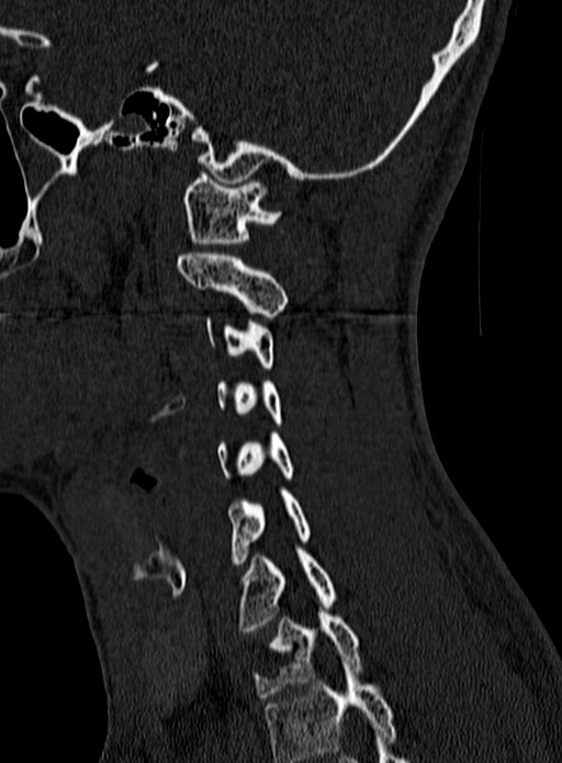 Atlantoaxial subluxation (Radiopaedia 44681-48450 Sagittal bone window 121).jpg