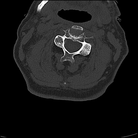 File:Atlas (type 3b subtype 1) and axis (Anderson and D'Alonzo type 3, Roy-Camille type 2) fractures (Radiopaedia 88043-104607 Axial bone window 31).jpg