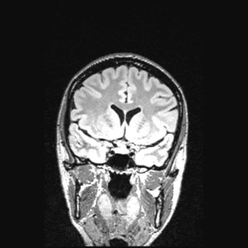 File:Atretic encephalocoele with inferior vermis hypoplasia (Radiopaedia 30443-31108 Coronal FLAIR 118).jpg