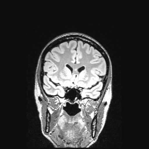 Atretic encephalocoele with inferior vermis hypoplasia (Radiopaedia 30443-31108 Coronal FLAIR 123).jpg