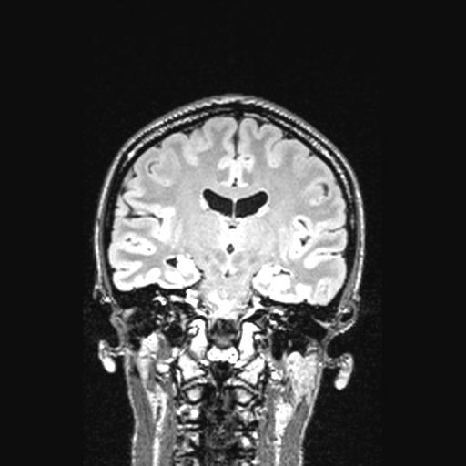 File:Atretic encephalocoele with inferior vermis hypoplasia (Radiopaedia 30443-31108 Coronal FLAIR 91).jpg