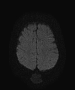 File:Atretic parietal cephalocele (Radiopaedia 64350-73135 Axial DWI 17).jpg
