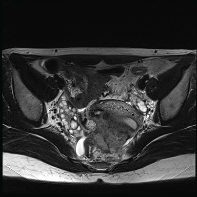 File:Atypical deep infiltrating endometriosis (Radiopaedia 44470-48125 Axial T2 14).jpg