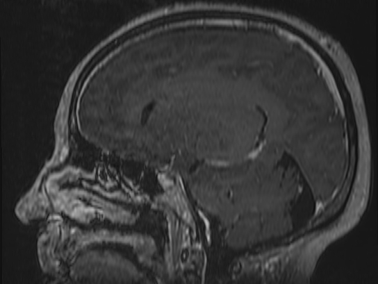 Atypical meningioma (Radiopaedia 62985-71406 Sagittal T1 C+ 52).jpg