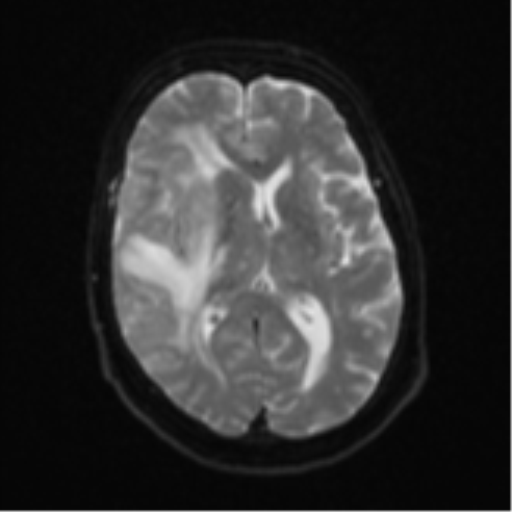Atypical meningioma (WHO Grade II) (Radiopaedia 54742-60979 Axial DWI 15).png