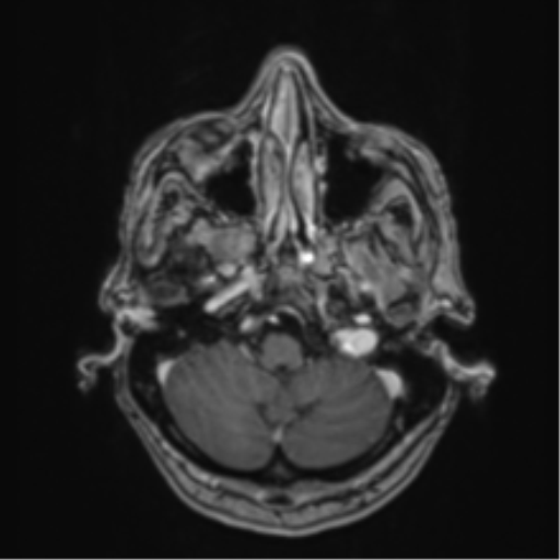 Atypical meningioma (WHO Grade II) (Radiopaedia 54742-60979 Axial T1 C+ 9).png