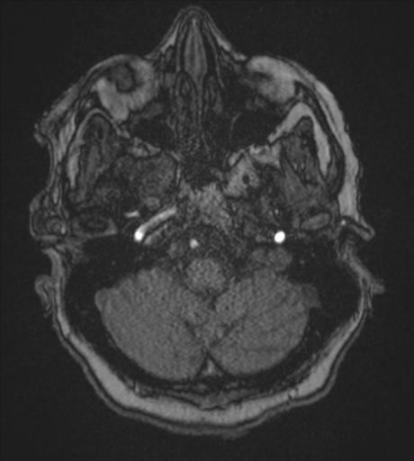 Atypical meningioma (WHO Grade II) (Radiopaedia 54742-60981 Axial MRA 18).png