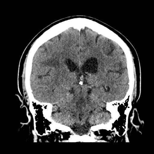 Atypical meningioma (WHO grade II) with brain invasion (Radiopaedia 57767-64728 Coronal C+ 39).png
