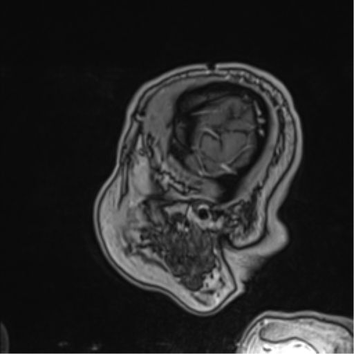 Atypical meningioma (WHO grade II) with brain invasion (Radiopaedia 57767-64729 Sagittal T1 C+ 59).png