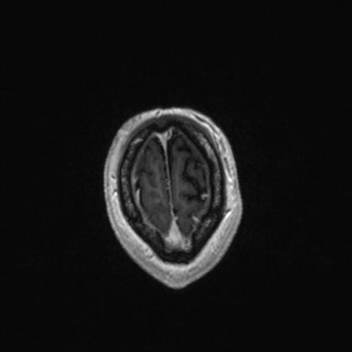 Atypical meningioma (grade II) - en plaque (Radiopaedia 29633-30147 Axial T1 C+ 164).jpg