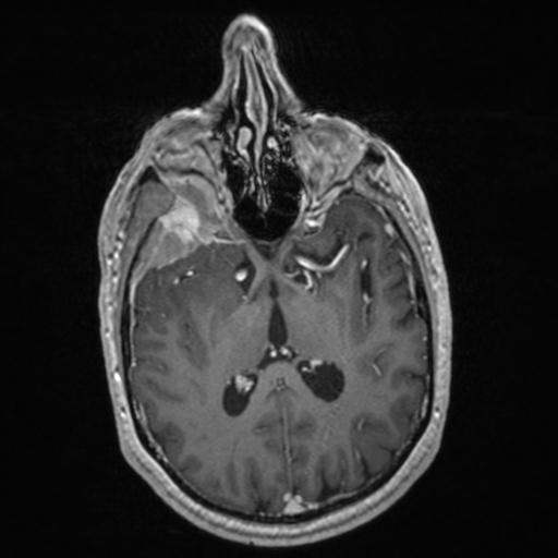 Atypical meningioma (grade II) - en plaque (Radiopaedia 29633-30147 Axial T1 C+ 92).jpg