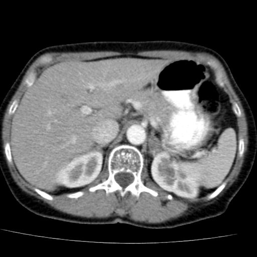 File:Atypical renal cyst (Radiopaedia 17536-17251 renal cortical phase 7).jpg