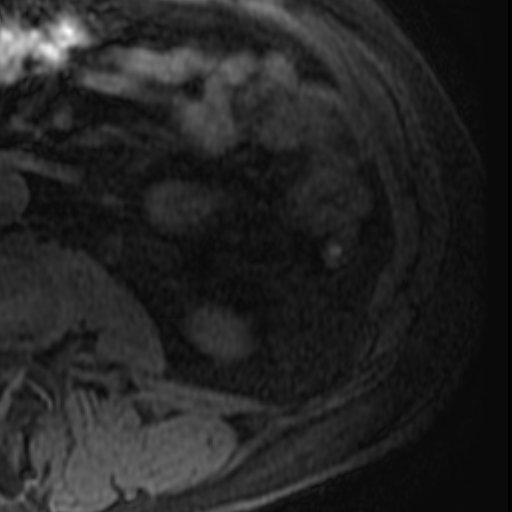 File:Atypical renal cyst on MRI (Radiopaedia 17349-17046 Axial T1 fat sat 30).jpg