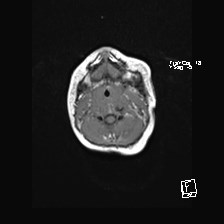 Atypical teratoid rhabdoid tumor (prenatal US and neonatal MRI) (Radiopaedia 59091-66388 Axial T1 2).jpg