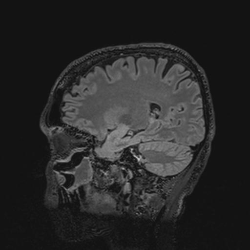 File:Autoimmune limbic encephalitis (Radiopaedia 30363-31005 Sagittal FLAIR 59).jpg