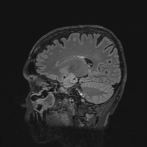 Autoimmune limbic encephalitis (Radiopaedia 30363-31005 Sagittal FLAIR 62).jpg