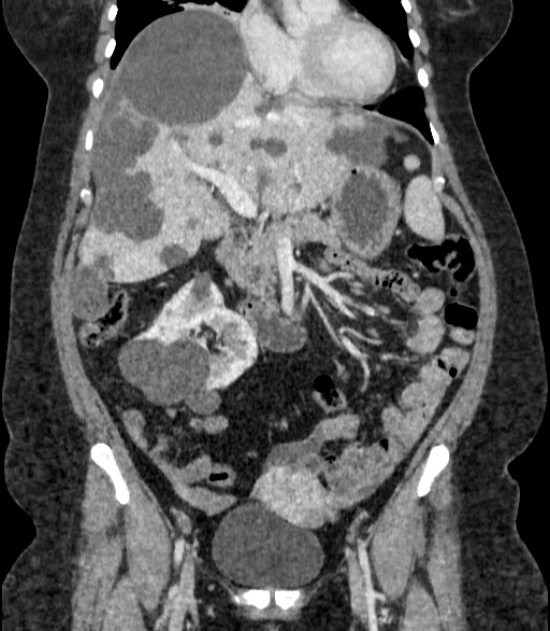 Autosomal dominant polycystic kidney disease (Radiopaedia 57124-64017 B 31).jpg