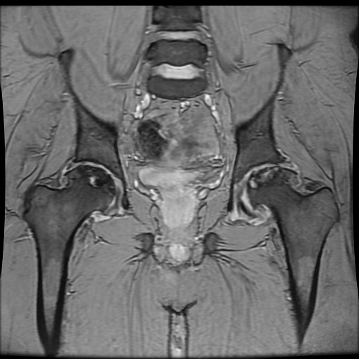 Avascular necrosis of the hip (Radiopaedia 61503-69465 F 53).jpg