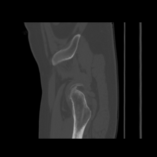 Avascular necrosis of the hip (Radiopaedia 61503-69467 B 53).jpg